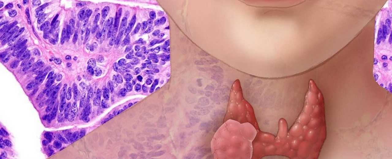 Диагностика рака щитовидной железы