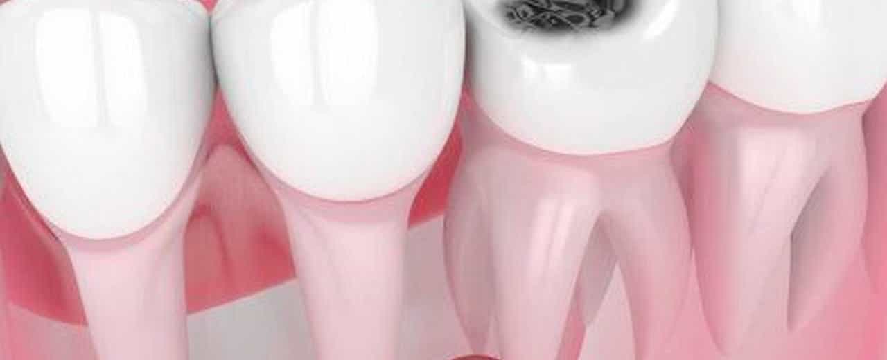Лечение черных точек на зубах. Причины и профилактика. Стоматологическая клиника Люми-Дент.