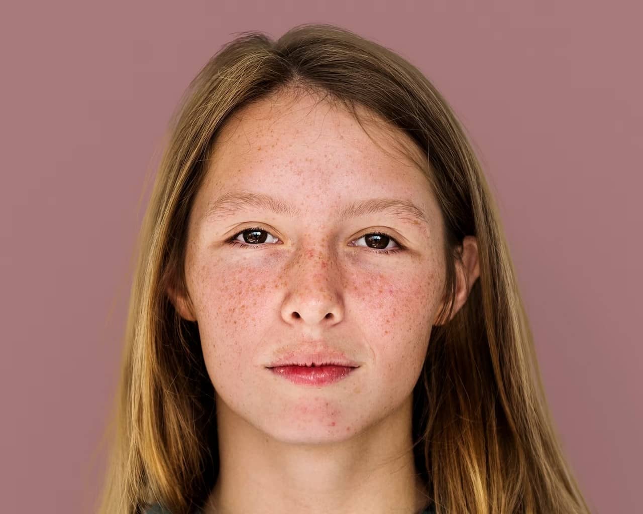 Сосудистые звездочки на коже: откуда берутся и что с ними делать